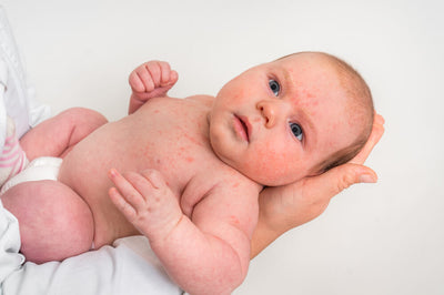 Does My Baby Have Eczema?