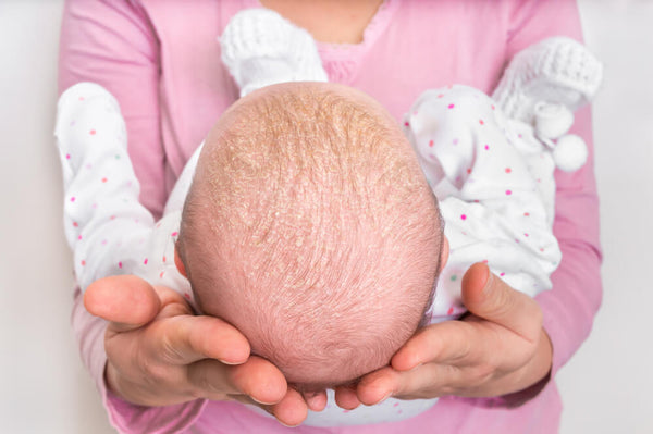 how to get rid of cradle cap