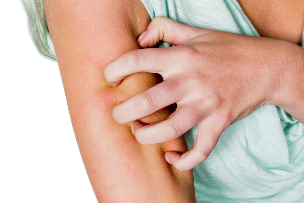 natural remedies for bug bites