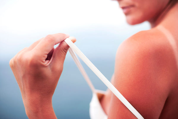 home remedies for sunburn